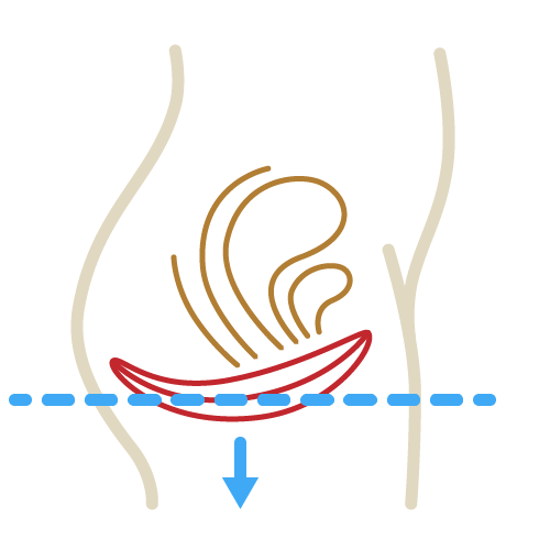 Illustration eines geschwächten Beckenbodens